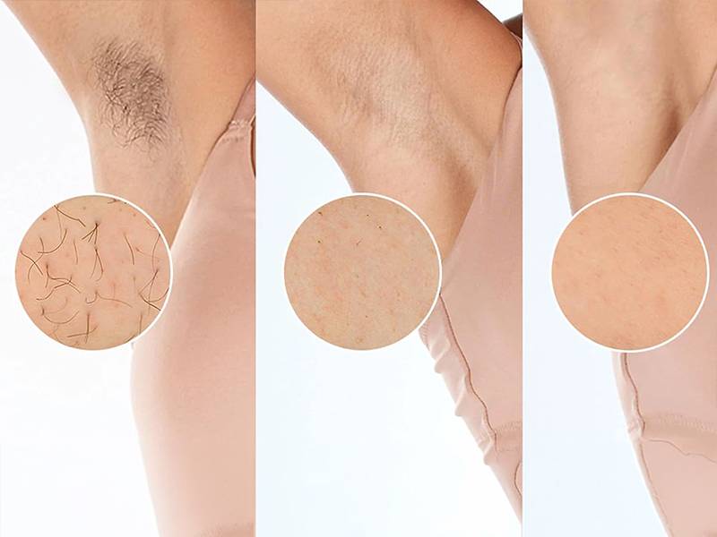 Depiladora de luz pulsada Philips Lumea S8000 BRI945-00 Resultados que convencen